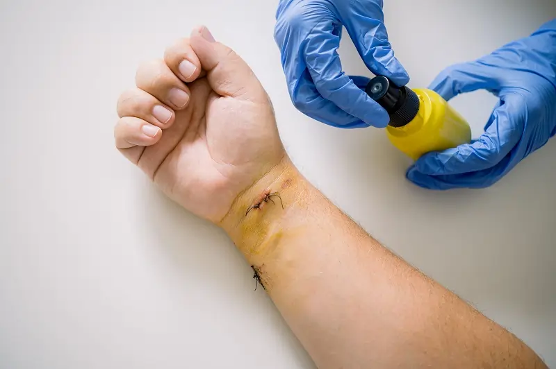 Chronic Wound Care Los Angeles, CA