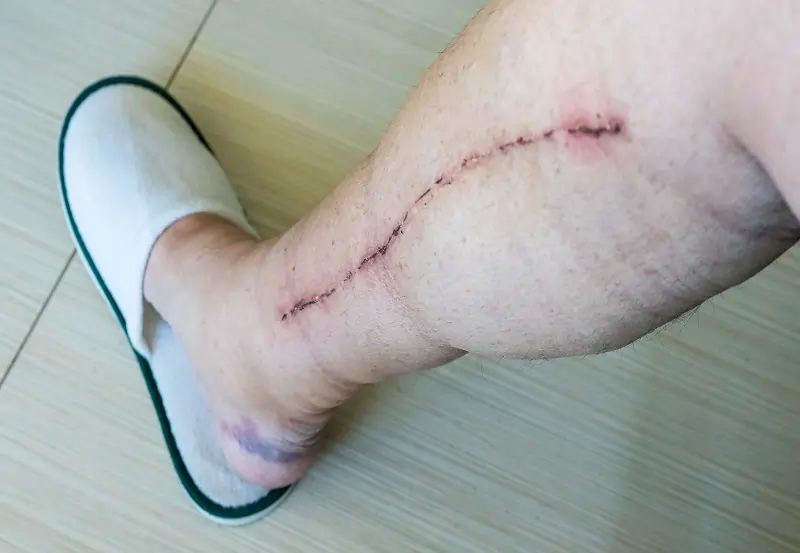 Chronic wounds need constant attention in Los Angeles