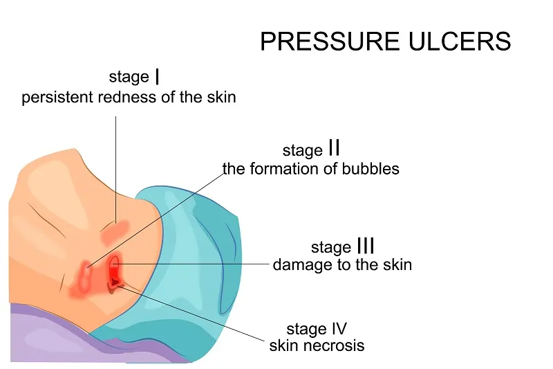 Early Signs of Pressure Ulcers- Los Angeles, CA