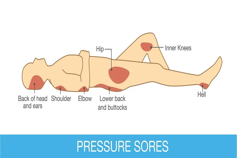 Pressure Ulcer Care LA, CA