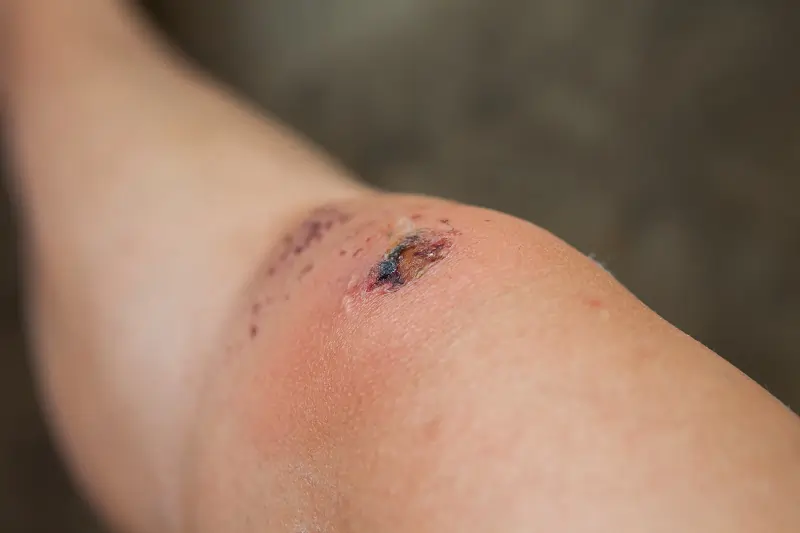 Non-healing wounds in Los Angeles, CA