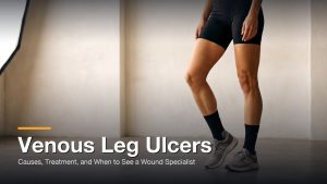Venous Leg Ulcers: Causes, Treatment, and When to See a Wound Specialist, Precision Wound Centers, Los Angeles